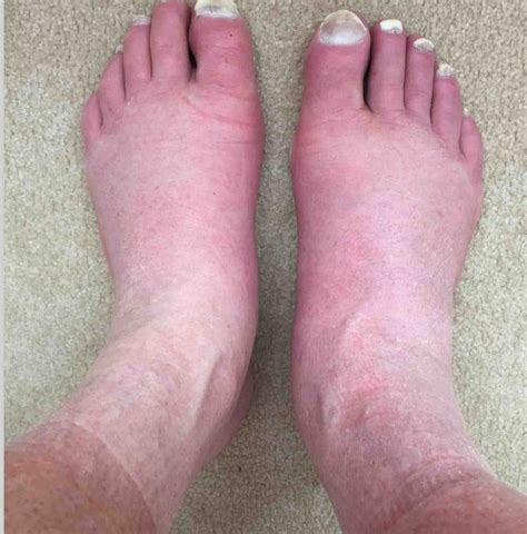 Dependent Edema The Most Common Cause Of Leg Swelling