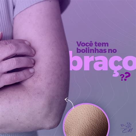 Você Tem Bolinhas No Braço Dra Elisângela Menezes