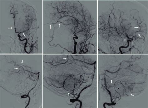 Cerebral Digital Subtraction Angiography DSA Showed Multiple Download Scientific Diagram