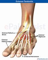 Toe Strain Treatment