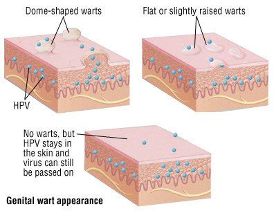 Genital Warts Guide Causes Symptoms And Treatment Options