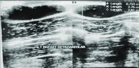 Sonographic Appearance Of The Breast Cyst Demonstrating A Download