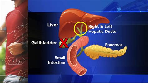 Moves In Medicine What Is Gallbladder Attack Gallstones Surgery