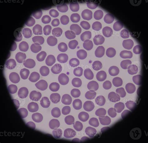 Normal Peripheral Blood Rbcs Are Normochromic Normocytic 945755 Stock