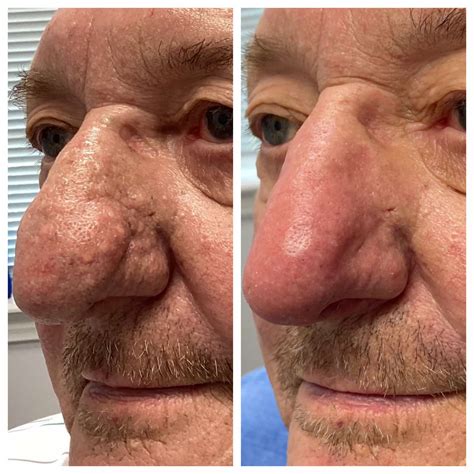 Rhinophyma Before And After