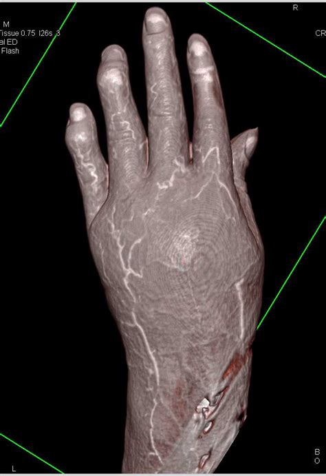 Distal Radius Fracture Repair And 3d Soft Tissue Imaging