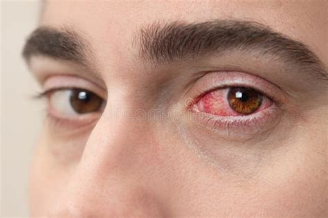 Close Up Of Severe Bloodshot Red Blood Eye Of Male Affected By
