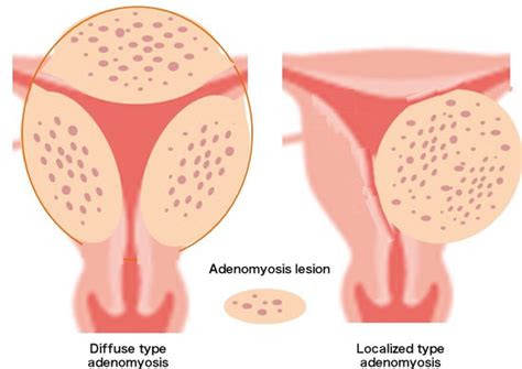 Obstetrics And Gynecology Disease：leiomyoma Endometriosis