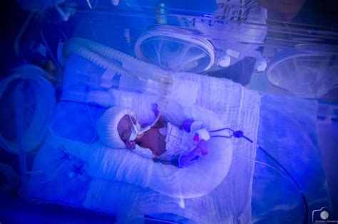 Medical Follow Up Can Reduce Premature Birth And Its Consequences