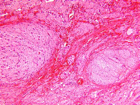 Pathology Outlines Ganglioneuroblastoma Intermixed And Nodular