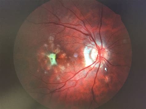 Patient Case White Dot Syndrome