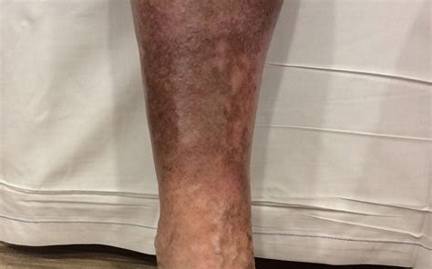 Opération Maladroit Atlas Brown Skin Discoloration On Lower Legs Agneau