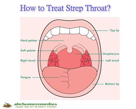 Natural Remedies To Cure Strep Throat Abchomeremedies