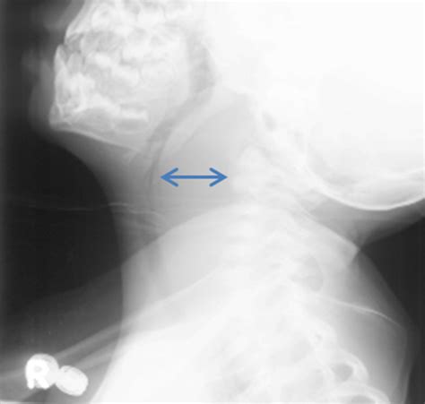 Lateral Neck X Ray Demonstrating Significant Retropharyngeal Thickening