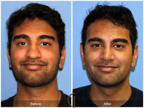 Male Rhinoplasty Before And After Photos From Dr Kevin Sadati