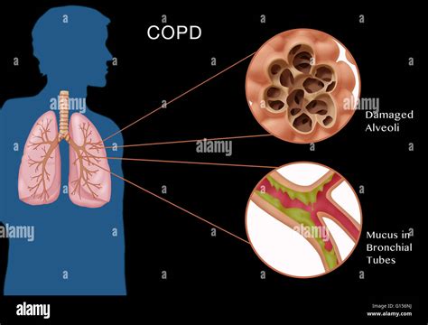 chronic obstructive pulmonary disease copd coggle diagram gambaran