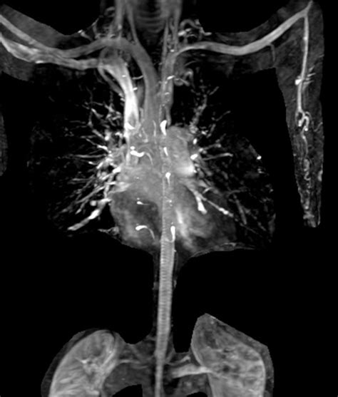 Coarctation Of Aorta Interesting Case Report Sumers Radiology Blog