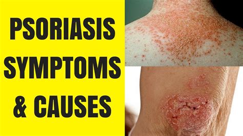 Psoriasis Pictures Psoriasis Pictures Symptoms Causes And Treatments
