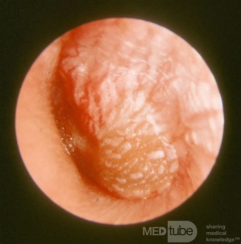 Severe Acute Otitis Media Left Ear Picture