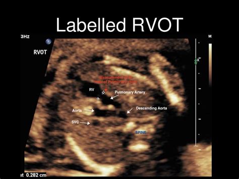 Labelled Fetal Heart Ultrasound