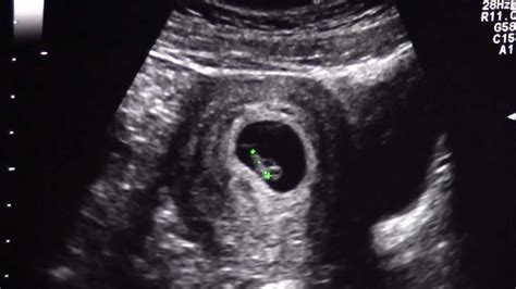 7 Weeks Old Ultrasound Of Our Baby Youtube