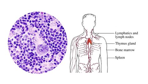 Lymphoma Types Causes Symptoms Diagnosis Treatment