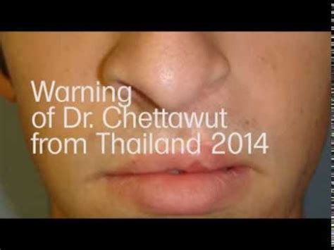 Dr Chettawut Tulayaphanich Md Sex Reassignment Surgery Facial