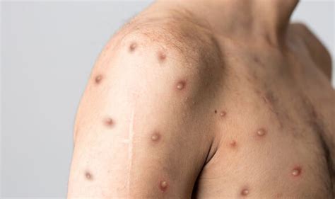 Monkeypox Pustules May Appear Before Any Other Symptoms Uk