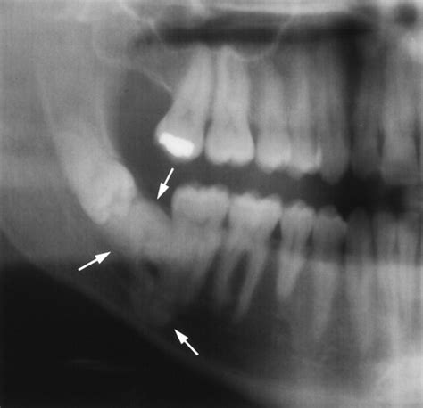 Cysts And Cystic Lesions Of The Mandible Clinical And Radiologic