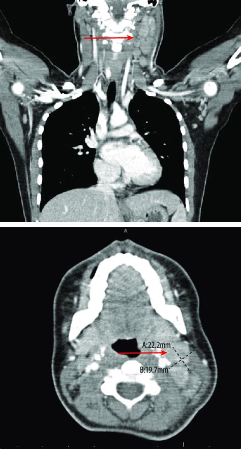 Ct Scan Revealed Enlarged Left Cervical Lymph Nodes Download