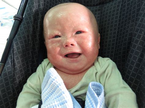 Lamellar Ichthyosis Baby