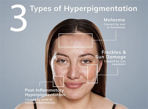 Hyperpigmentation Vs Hypopigmentation Causes Treatments And Products