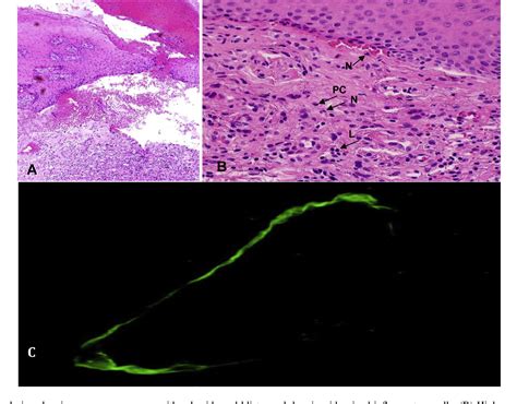 Mucous Membrane Pemphigoid With Severe Supraglottic Stenosis And