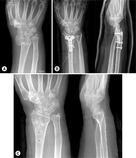 Distal Radius Intraarticular Fracture And Ulnar Styloid Process My XXX Hot Girl