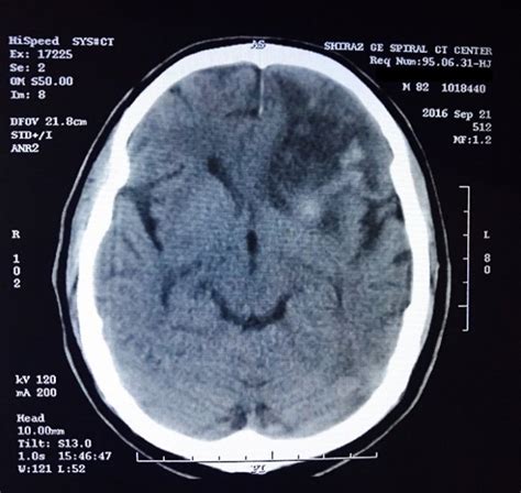 Brain Computerized Tomography Ct Scan Indicating A Hemorrhage In The