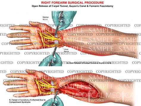 Forearm Compartment Syndrome Fasciotomy — Medical Art Works