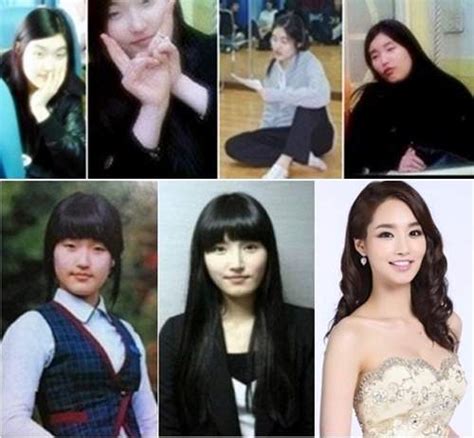Best 5 Korean Plastic Surgery Before And After Photos
