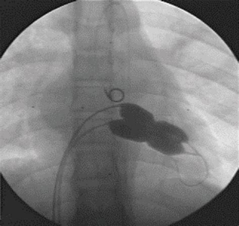 Double Balloon Percutaneous Mitral Balloon Valvuloplasty Using The Download Scientific Diagram