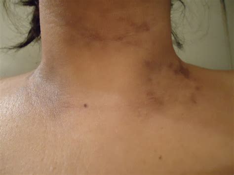 Dark Spots On My Neck What Is This Skin And Beauty Community