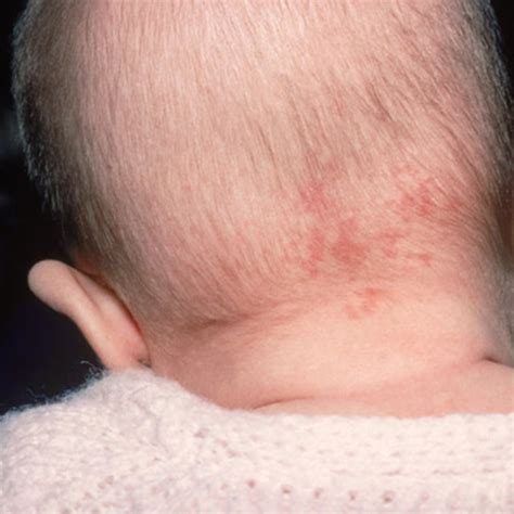 Red Spots On Scalp Diagnosis Remedies And More Insight Derma Clinic