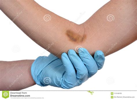 Bruise On Forearm From An Accident Stock Image Image Of Emergency