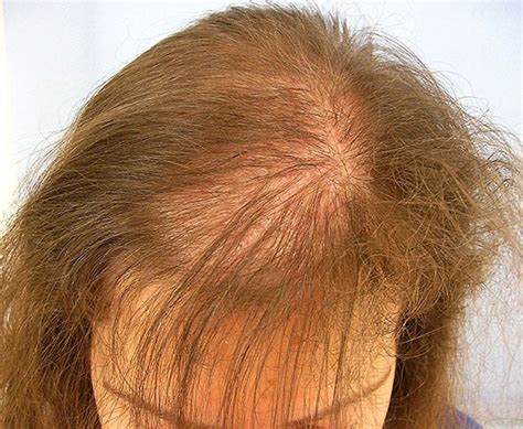 Women Hair Loss Treatment In Lahore Free Checkup And Consultation Call Us