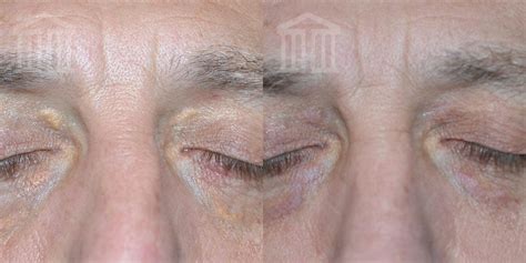 Xanthelasma Removal Zenith Cosmetic Clinics