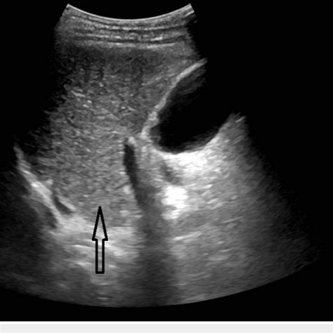 The Arrow Displays An Ultrasound Section Through The Right Oblique Download Scientific Diagram