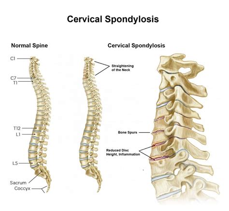 Cervical Spondylosis Treatment In Fairfax Va Sapna Spine And Pain
