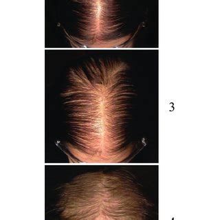 Sinclair Hair Loss Severity Scale For Female Pattern Hair Loss Download Scientific Diagram