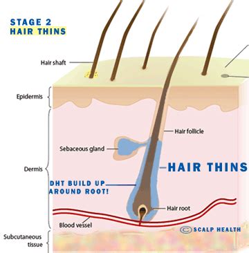 Diagnose your hair loss problem with dhi malaysia doctors at selangor / kuala lumpur clinic. ANTI DHT Hair Loss Treatment Malaysia [How To Combat DHT ...