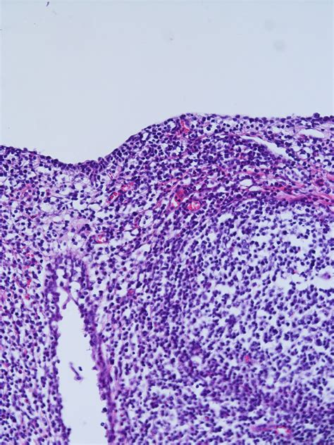 Anatomical Location Of Nasal Associated Lymphoid Tissue Nalt In