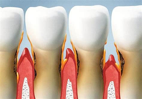 Dr Caputo Dentist In Palm Harbor Fl Dental Implants And Emergencies