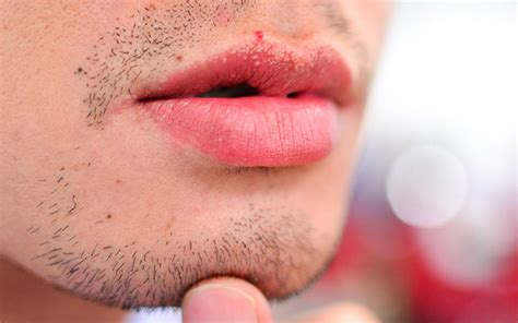 Fordyce Spots White Bumps On Lips Symptoms Causes Treatments And Ri